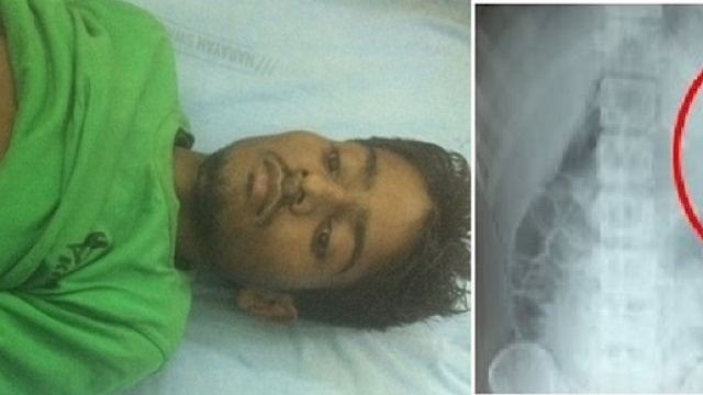 Il ragazzo ha convissuto per 15 anni con il suo gemello inconsapevolmente.