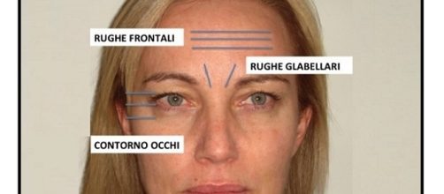 Le rughe sul viso non sono tutte uguali. Oggi la medicina estetica ha a disposizione diversi prodotti e tecniche di intervento.