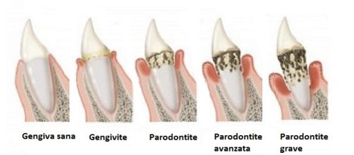 La parodontite è una patologia a carico di gengive e denti con effetti su altre patologie. È importante identificare i batteri responsabili.