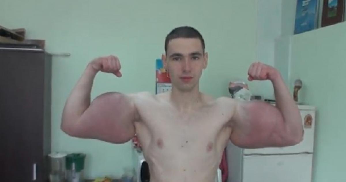 Jovem injeta óleo nos músculos e fica com os 'braços do Hulk'; veja