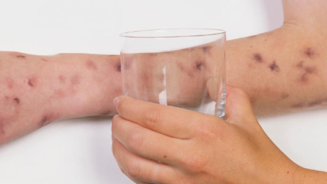 MENINGITE: tutti i segni che NON dovete ignorare. Ecco perch&egrave; si ... - retenews24.it