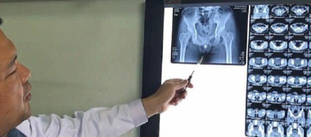 Médicos examinaram o homem e descobriram o cadeado Médicos examinaram o homem e descobriram o cadeado
