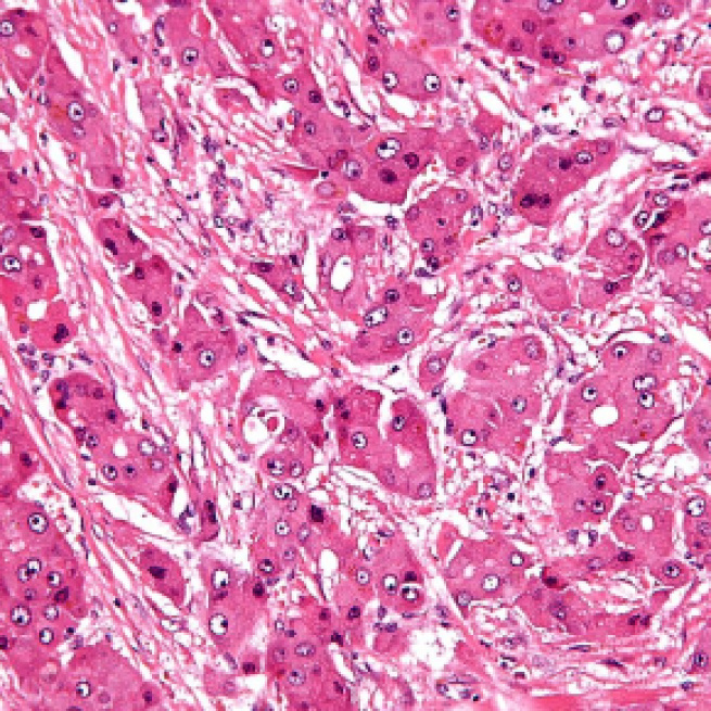 High magnification micrograph of FL-HCC. - [Image via Nephron / Wikimedia Commons]