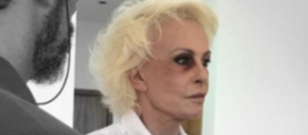 Ana Maria Braga surge com olho roxo Ana Maria Braga surge com olho roxo