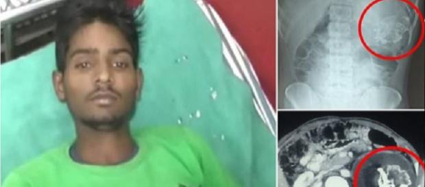 Homem tinha feto de 18 anos dentro de si Homem tinha feto de 18 anos dentro de si
