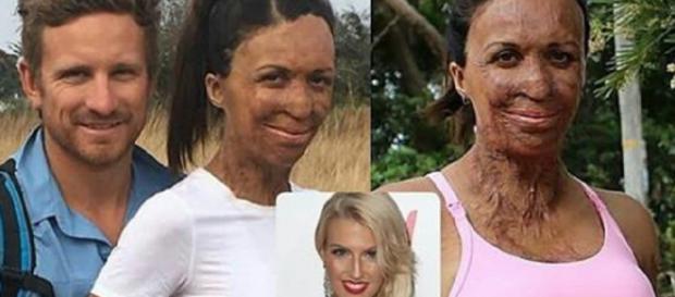 Turia Pitt, a mulher guerreira que venceu todas as batalhas Turia Pitt, a mulher guerreira que venceu todas as batalhas