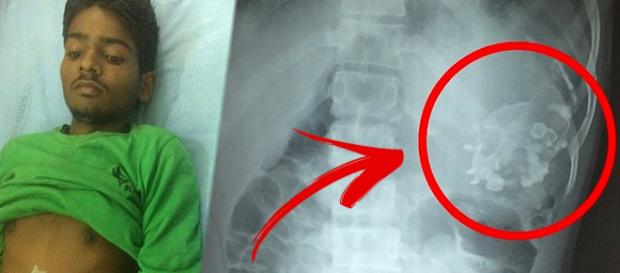Indiano viveu por 18 anos com feto parasita dentro da barriga Indiano viveu por 18 anos com feto parasita dentro da barriga