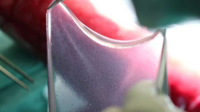 parte di epidermide impiantata al ragazzo