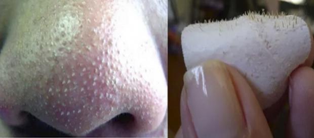 Quer saber como se livrar de cravos e espinhas? Confira! Quer saber como se livrar de cravos e espinhas? Confira!