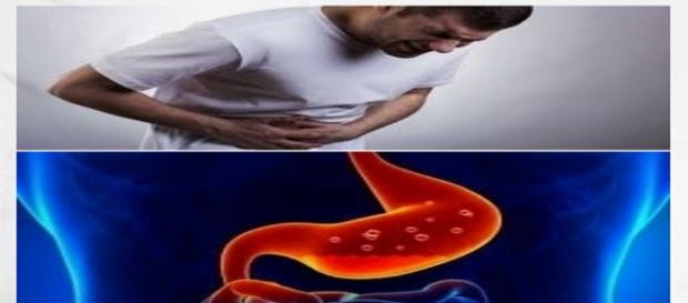 solucion para gastritis – conoce un poco más de esta enfermedad - solucionespara.com solucion para gastritis – conoce un poco más de esta enfermedad - solucionespara.com