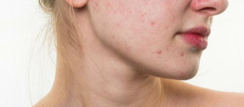 Cómo eliminar el acné con remedios naturales