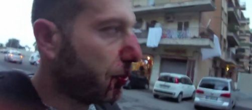 Daniele Piervincenzi, frattura al naso dopo l'aggressione di Roberto Spada