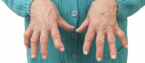 Baricitimib, la pastiglia contro l'artrite reumatoide rimborsabile dal Servizio Sanitario Nazionale