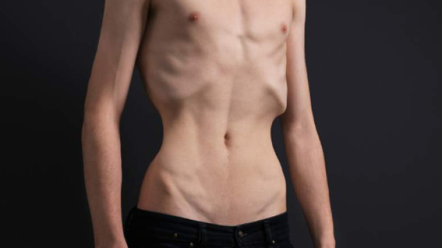 Disturbi alimentari, sempre pi&ugrave; maschi affetti da anoressia | Vvox - vvox.it