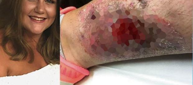 Mulher leva picada de aranha na perna Mulher leva picada de aranha na perna