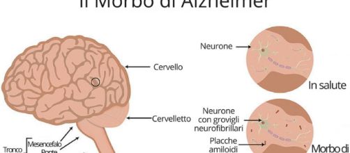 Alzheimer, neuroinfiammazione e placche amiloidi