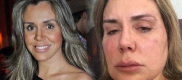 'Meu rosto derreteu': veja como está Renata Banhara; imagem forte 'Meu rosto derreteu': veja como está Renata Banhara; imagem forte