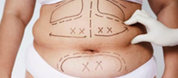 CFM aprova redução de estômago para tratamento de diabete. CFM aprova redução de estômago para tratamento de diabete.