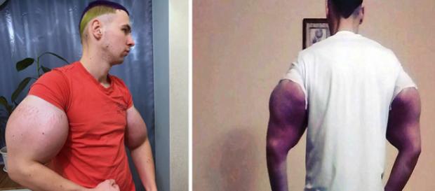 Și-a injectat singur o soluție de Synthol preparată acasă, pentru a-și crește masa musculară - Foto: Daily Mail (© VKontakte/east2west news) Și-a injectat singur o soluție de Synthol preparată acasă, pentru a-și crește masa musculară - Foto: Daily Mail (© VKontakte/east2west news)
