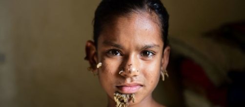 Sahana (10) kan være den første jenta diagnotisert med «tremann ... - vg.no