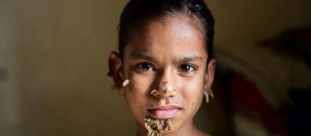 Sahana (10) kan være den første jenta diagnotisert med «tremann ... - vg.no Sahana (10) kan være den første jenta diagnotisert med «tremann ... - vg.no