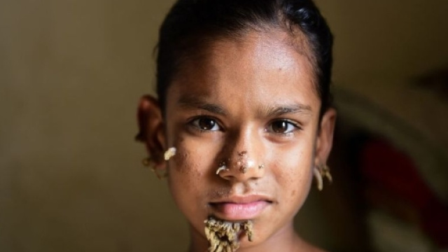 Sahana (10) kan være den første jenta diagnotisert med «tremann ... - vg.no