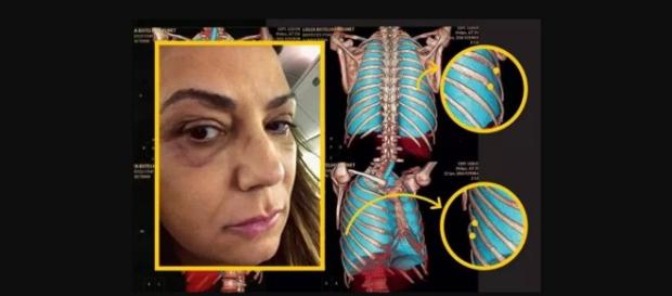 Luiza Brunet e a agressão - Imagem/Google Luiza Brunet e a agressão - Imagem/Google