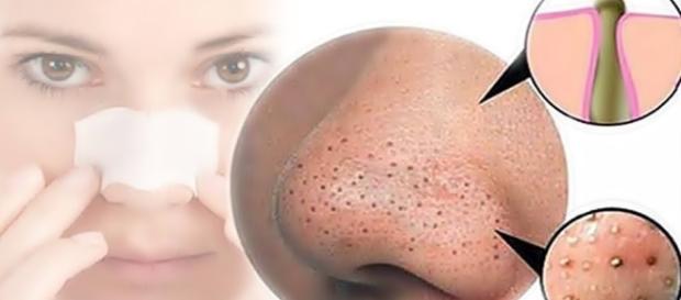 1000 ideias sobre Melasma Tratamento no Pinterest | Tratamento De ... - pinterest.com 1000 ideias sobre Melasma Tratamento no Pinterest | Tratamento De ... - pinterest.com