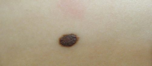 'Clicca il neo', arriva l'app per sconfiggere il melanoma (fonte http://www.centrostudigised.it)