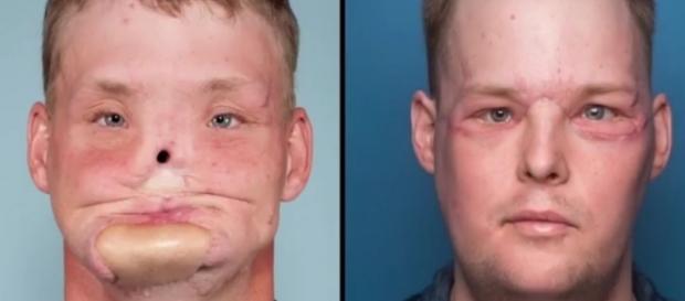 Andy Sandness passou por um transplante facial (Crédito: YouTube/YourOpinion) Andy Sandness passou por um transplante facial (Crédito: YouTube/YourOpinion)