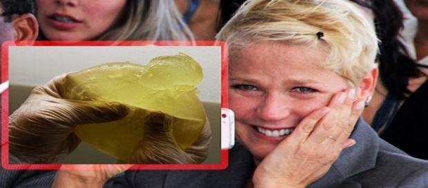 Xuxa é operada após sofrer problemas com silicone Xuxa é operada após sofrer problemas com silicone