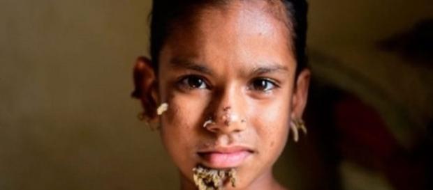 O pai de Sahana, torce para que os médicos possam conseguir tirar esses 'galhos' do lindo rostinho de sua filha O pai de Sahana, torce para que os médicos possam conseguir tirar esses 'galhos' do lindo rostinho de sua filha