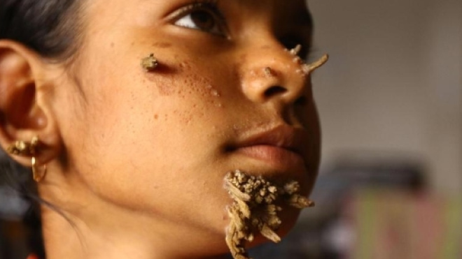 Schoolgirl, 10, with bark-like warts sprouting all over her face ... - thesun.co.uk