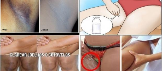 Dicas poderosas para auxiliar no clareamento de axilas, joelhos e cotovelos Dicas poderosas para auxiliar no clareamento de axilas, joelhos e cotovelos