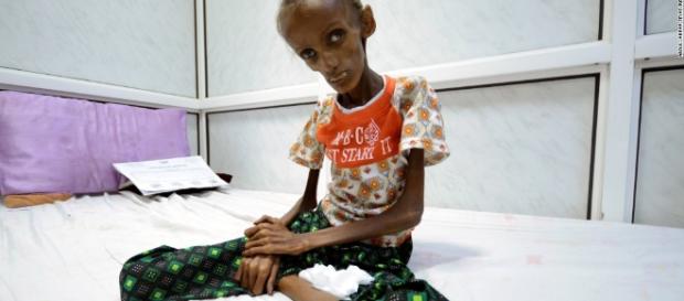 Yemen food crisis leaves millions at risk of starving - CNN.com - cnn.com Yemen food crisis leaves millions at risk of starving - CNN.com - cnn.com