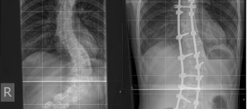 X-Rays of spine with scoliosis before and after spinal fusion and Harrington Rods.