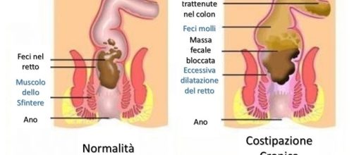 I sintomi della stitichezza - Consulenza Online