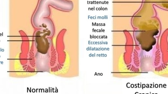 I sintomi della stitichezza - Consulenza Online