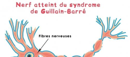 Le syndrome de Guillain-Barré.