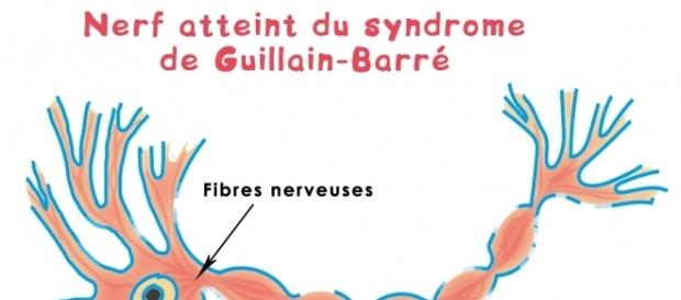 Le syndrome de Guillain-Barré. Le syndrome de Guillain-Barré.
