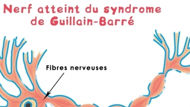 Le syndrome de Guillain-Barré.
