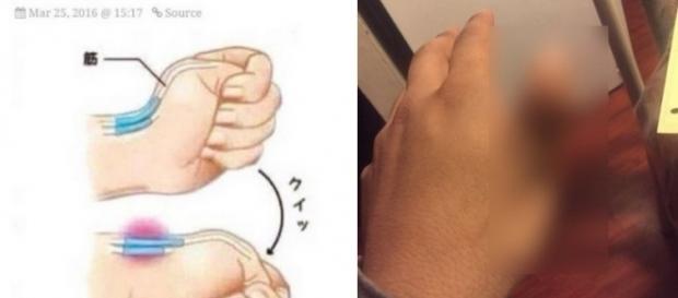 Le nouveau phénomène internet : se casser le ligament du pouce. On croit rêver ! Le nouveau phénomène internet : se casser le ligament du pouce. On croit rêver !