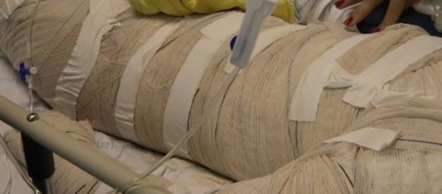 Menino de 11 anos tem queimaduras Menino de 11 anos tem queimaduras