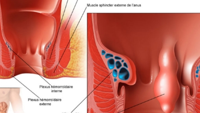 Emorroidi: Il Ciclismo Peggiora Il Dolore - salute-e-benessere.org
