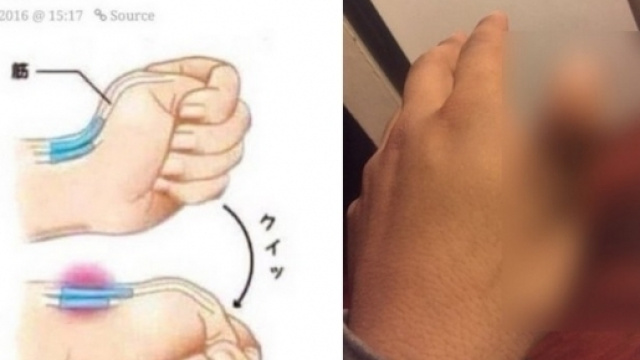 Le nouveau ph&eacute;nom&egrave;ne internet : se casser le ligament du pouce. On croit r&ecirc;ver !