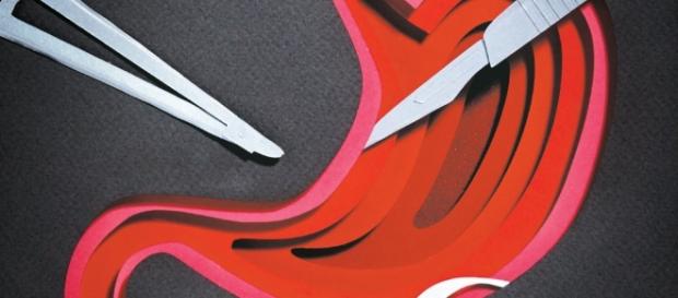 A cirurgia bariátrica é indicada apenas em casos específicos A cirurgia bariátrica é indicada apenas em casos específicos