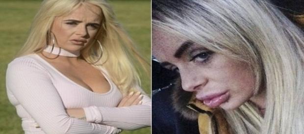 Após colocar botox em casa, britânica fica com a boca inchada. Após colocar botox em casa, britânica fica com a boca inchada.