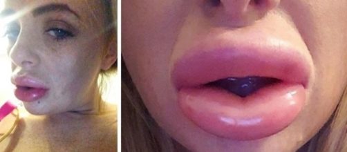 Segundo Leona, seus lábios ficaram parecidos com duas salsichas