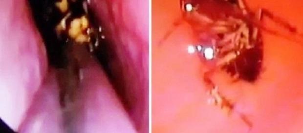 Barata viva é encontrada dentro do crânio de mulher indiana Barata viva é encontrada dentro do crânio de mulher indiana