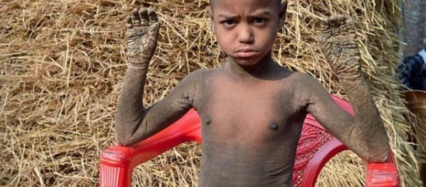 Imagem do garoto de Bangladesh diagnosticado com doença rara Imagem do garoto de Bangladesh diagnosticado com doença rara